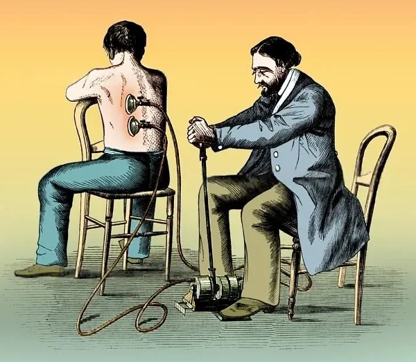 Illustration of cupping with a mechanical pump